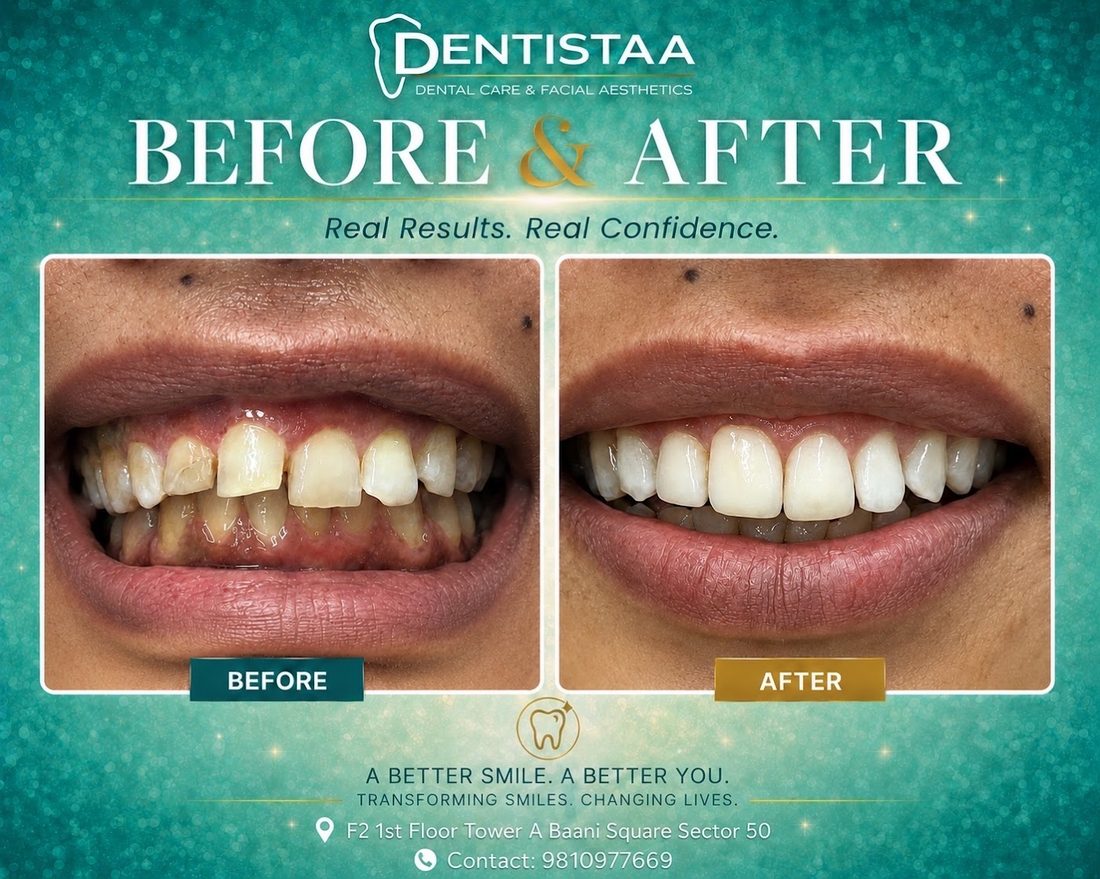 Smile transformation: worn and uneven front teeth rebuilt.