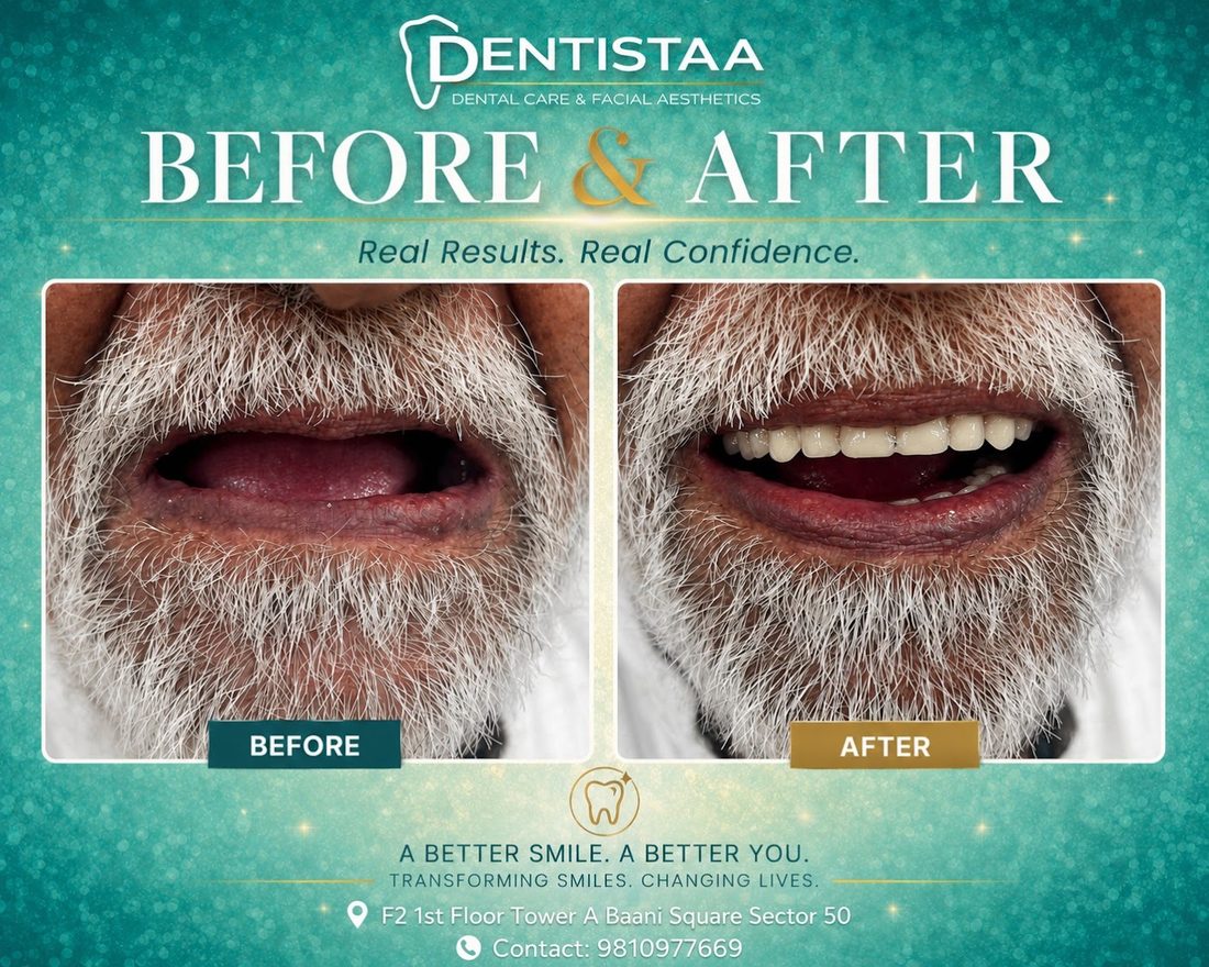 Missing lower teeth replaced and the bite restored.